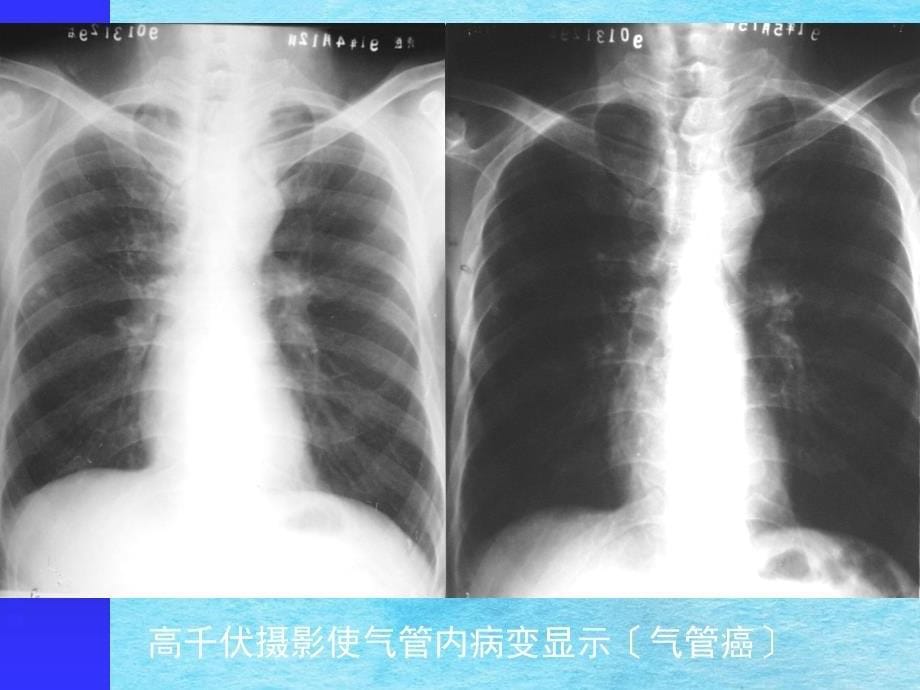 正常胸部影像学ppt课件_第5页