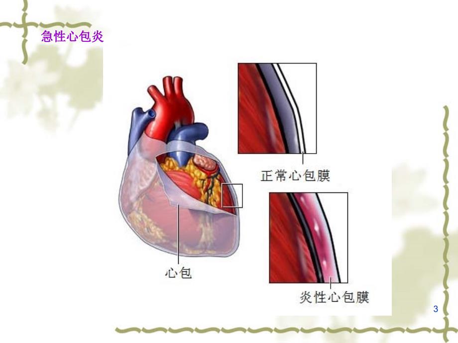 急性心包炎心电图表现PPT优秀课件_第3页