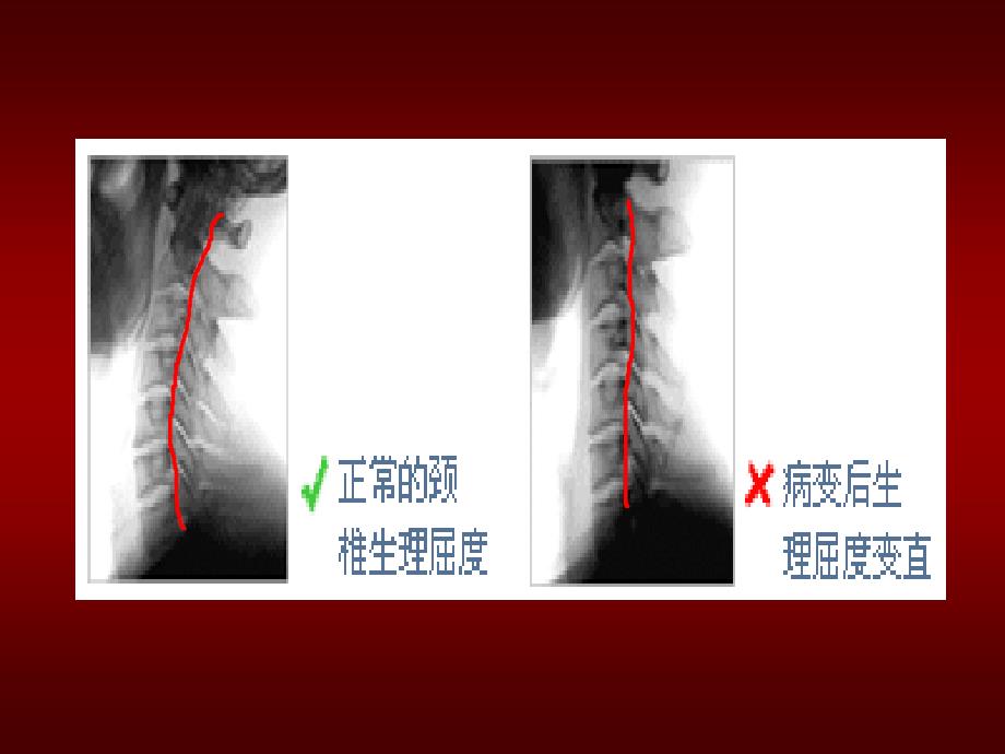 办公室保健、颈椎、腰椎病预防讲座_第4页