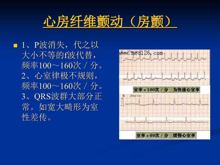 各种心电图表现_第1页