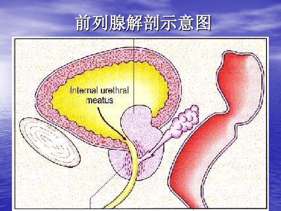 TURP并发症及其防治_第1页