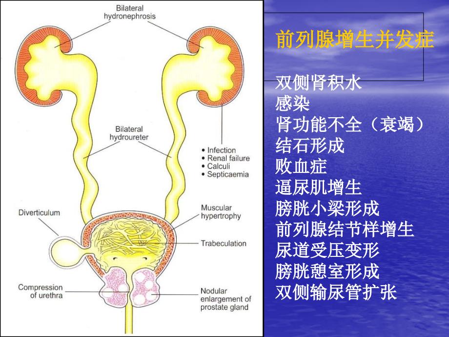 TURP并发症及其防治_第2页