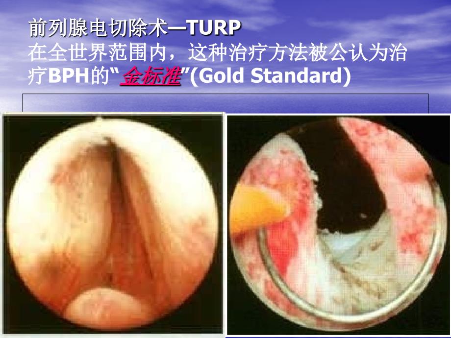 TURP并发症及其防治_第3页