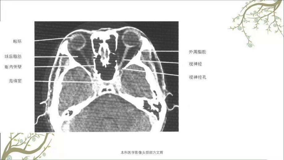 本科医学影像头颈部方文辉课件_第4页