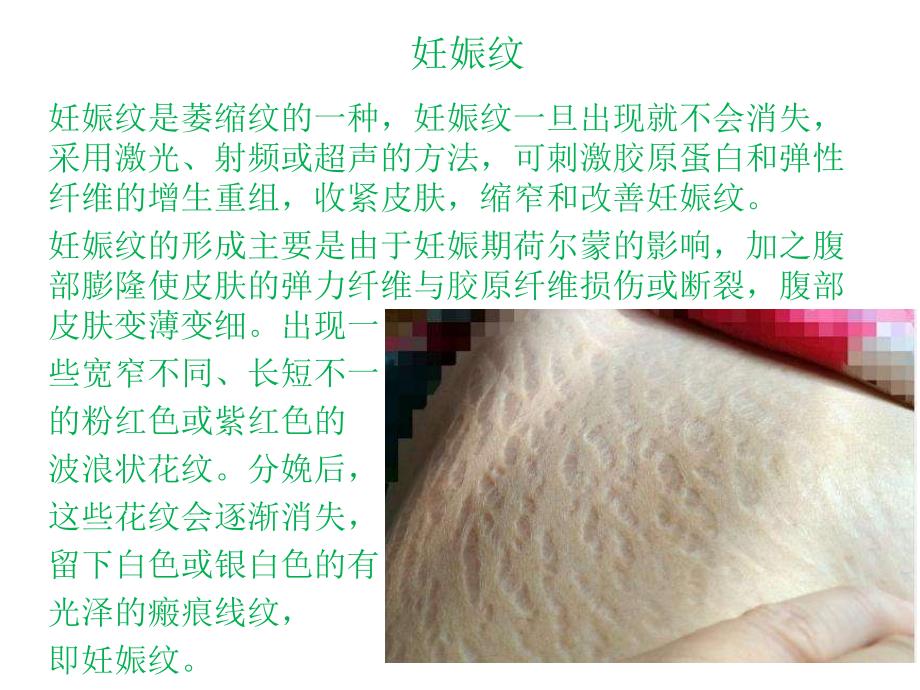 妊娠纹的详细讲解.ppt_第3页