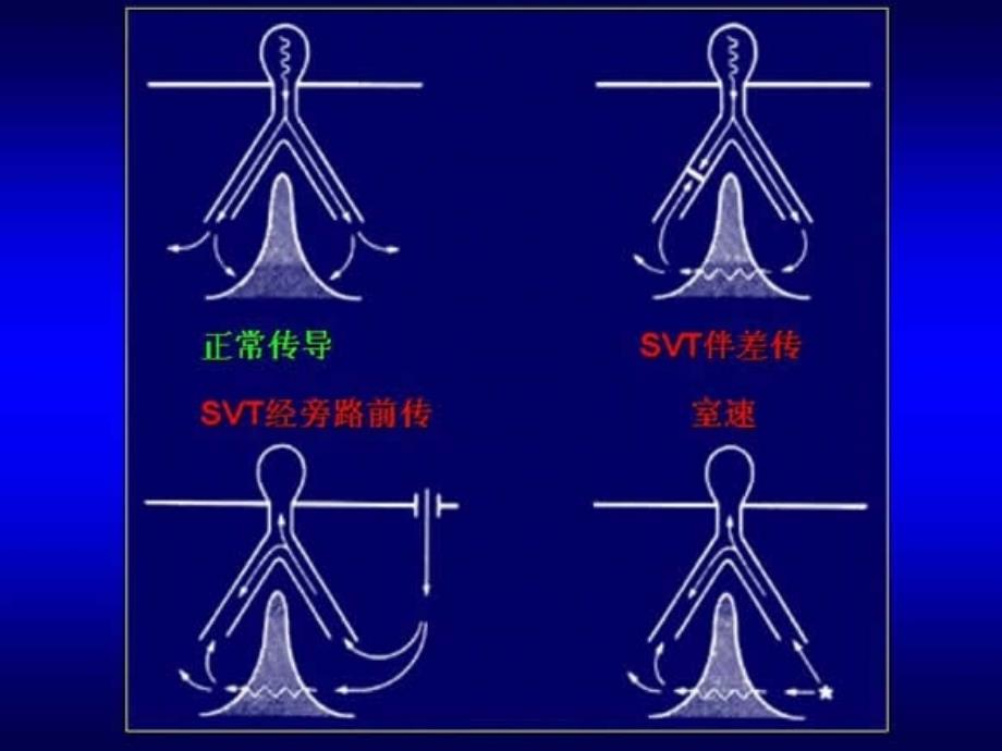 宽QRS心动过速的鉴别诊断_第4页