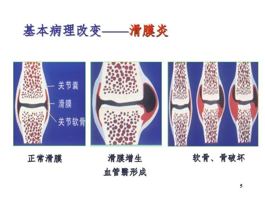 类风湿性关节炎PPT幻灯片_第5页