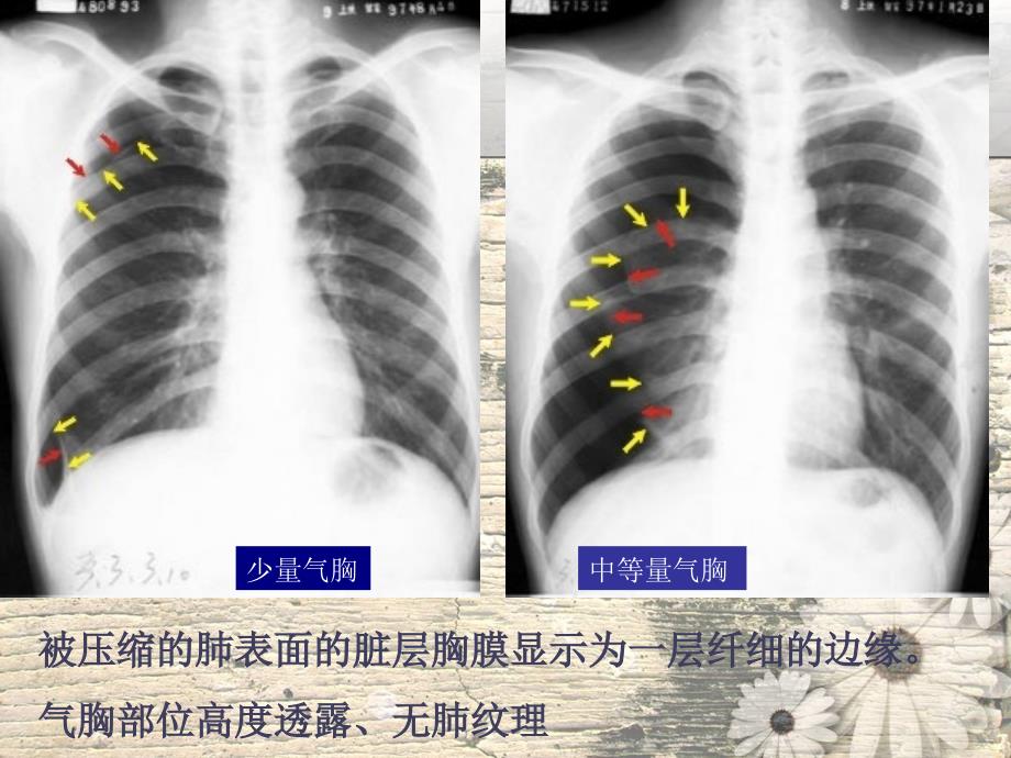 呼吸系统见疾病影像学表现ppt课件_第3页