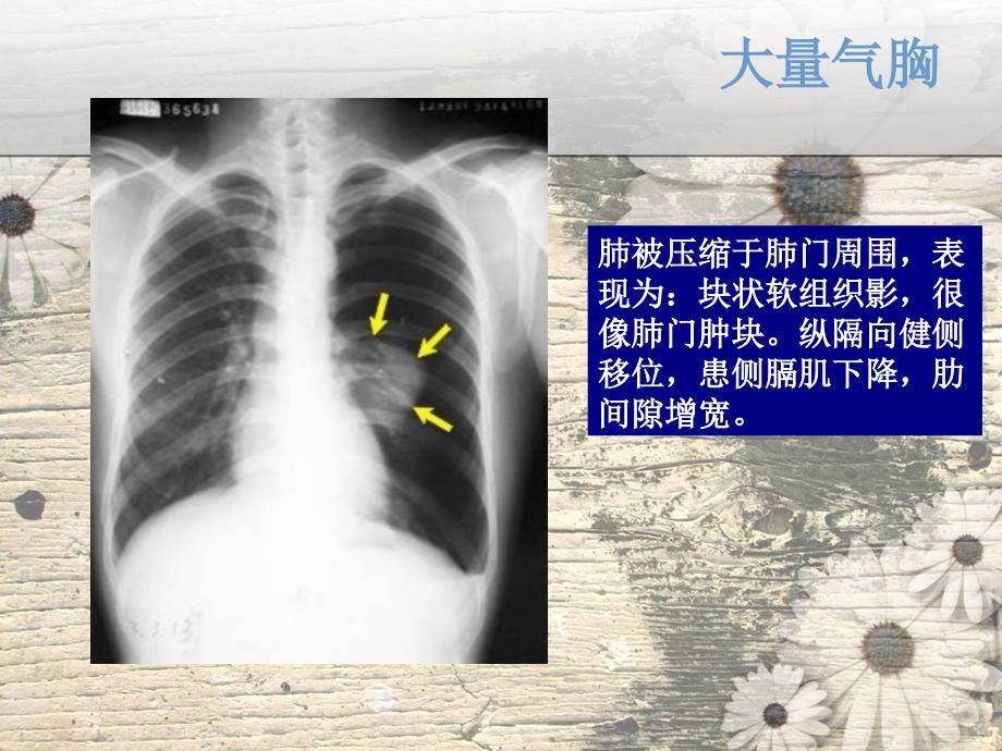 呼吸系统见疾病影像学表现ppt课件_第4页