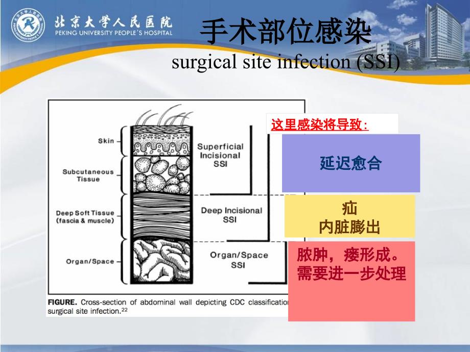 外科抗生素的预防和使用原则_第4页