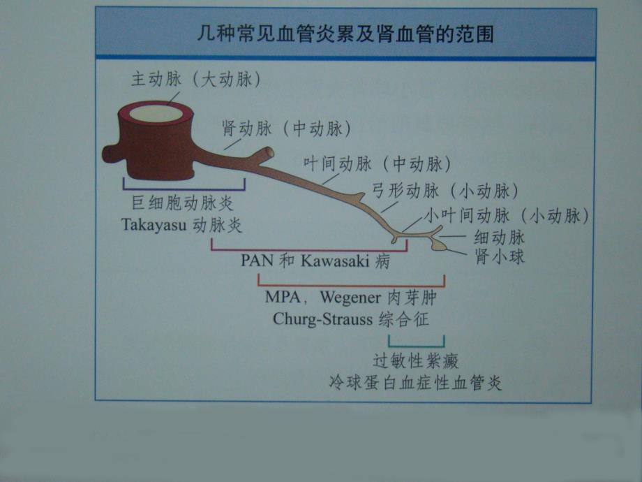 ANCA相关性血管炎诊疗进展ppt课件_第4页