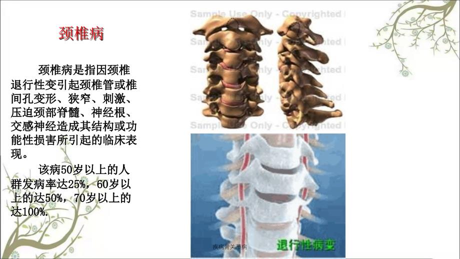 疾病骨关节病课件_第4页