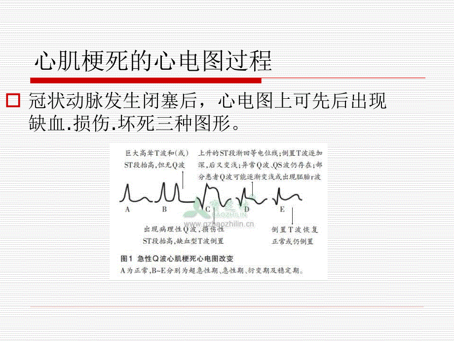 《心肌梗死的心电图表现》课件_第4页