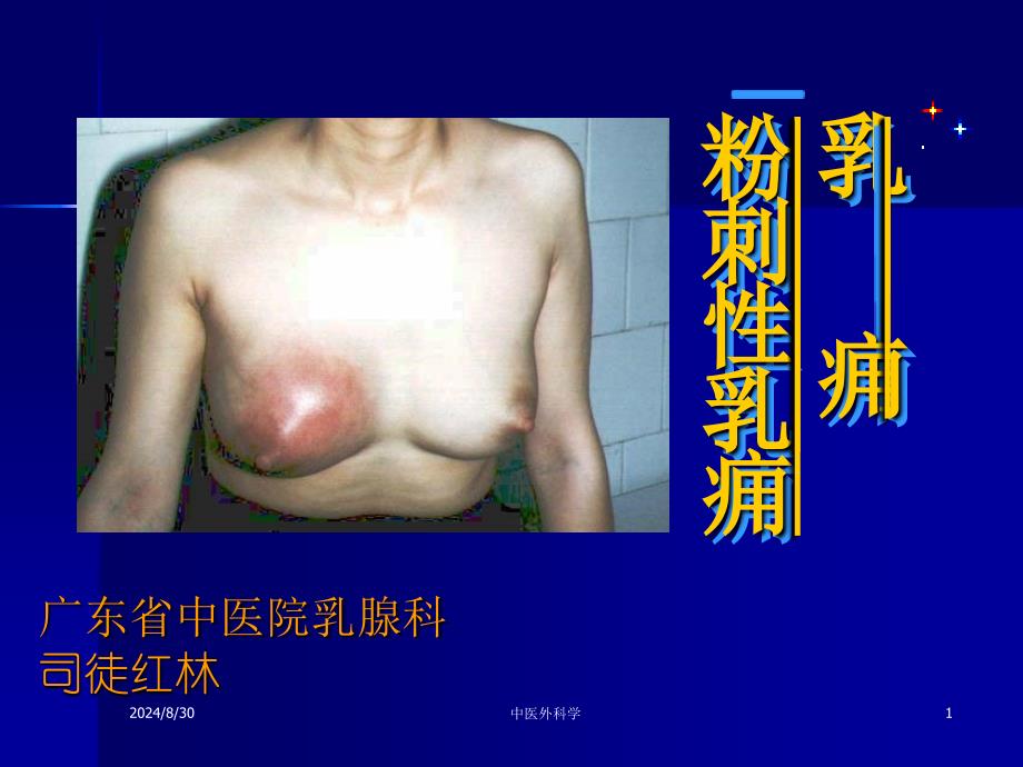 乳痈粉刺性乳痈.ppt_第1页