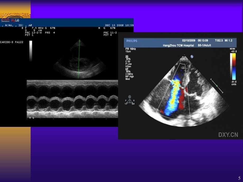 优质医学心脏彩超的临床应用_第5页