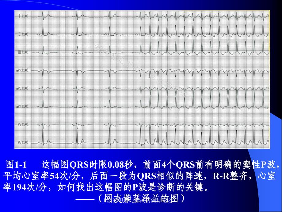 P波的识别与相关病例讨论之一课件_第3页