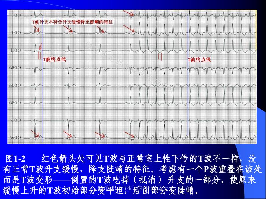 P波的识别与相关病例讨论之一课件_第4页