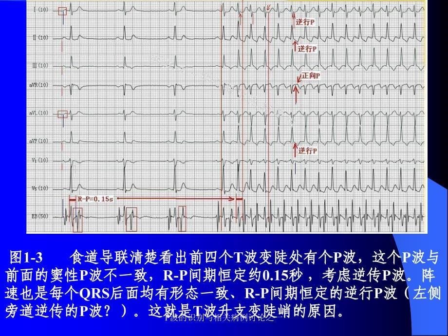 P波的识别与相关病例讨论之一课件_第5页