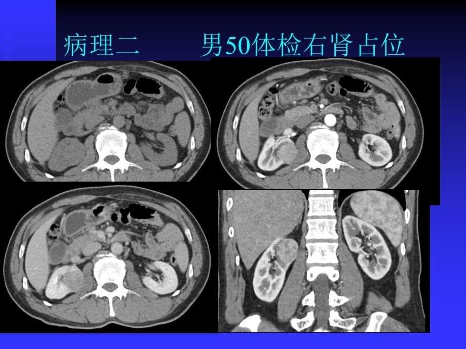 肾血管平滑肌脂肪瘤病例随访_第5页