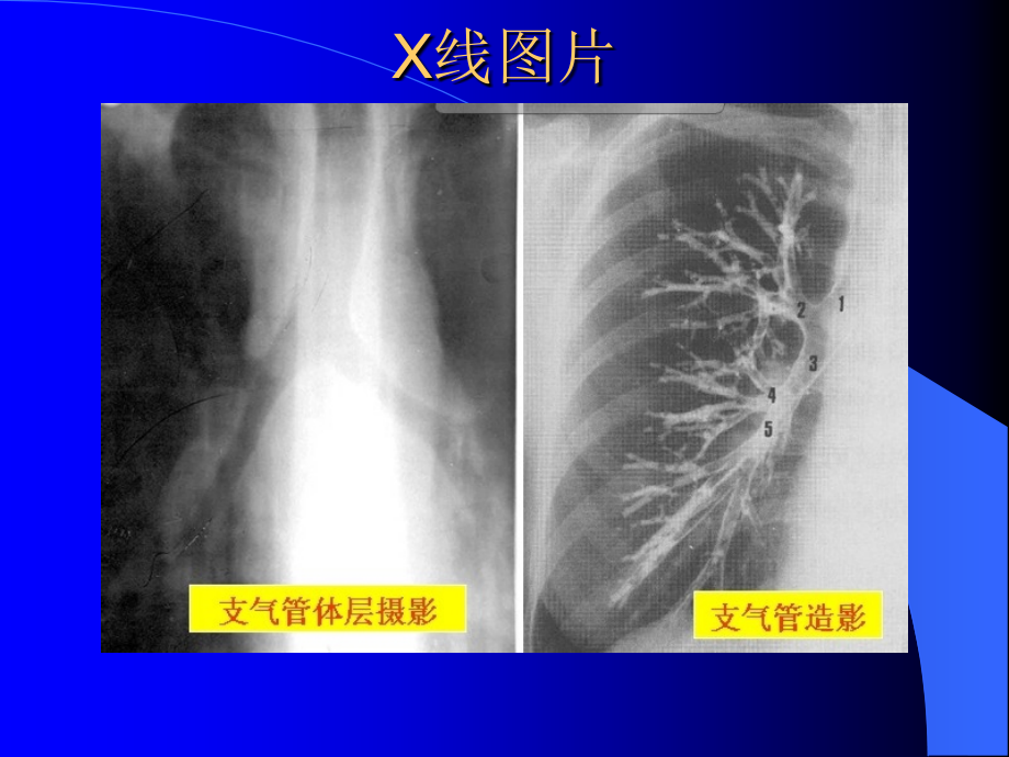 临床医学呼吸X线CT总论临床修改好_第4页