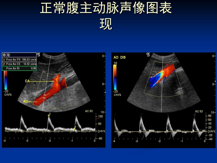 超声医学课件：腹膜后大血管_第4页