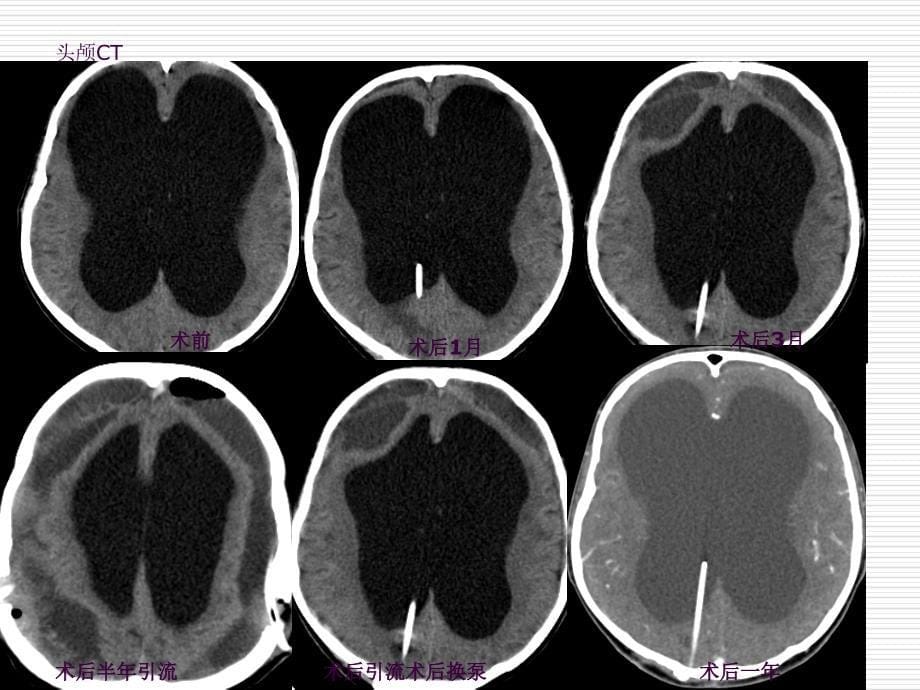 中国脑积水规范化治疗专家共识解读ppt课件_第5页