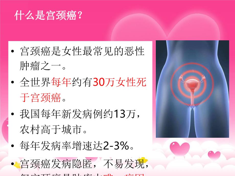 宫颈癌筛查健康宣讲课件_第2页