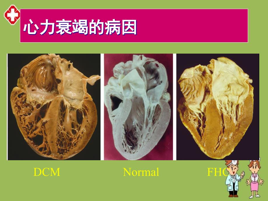 心力衰竭护理ppt_第4页