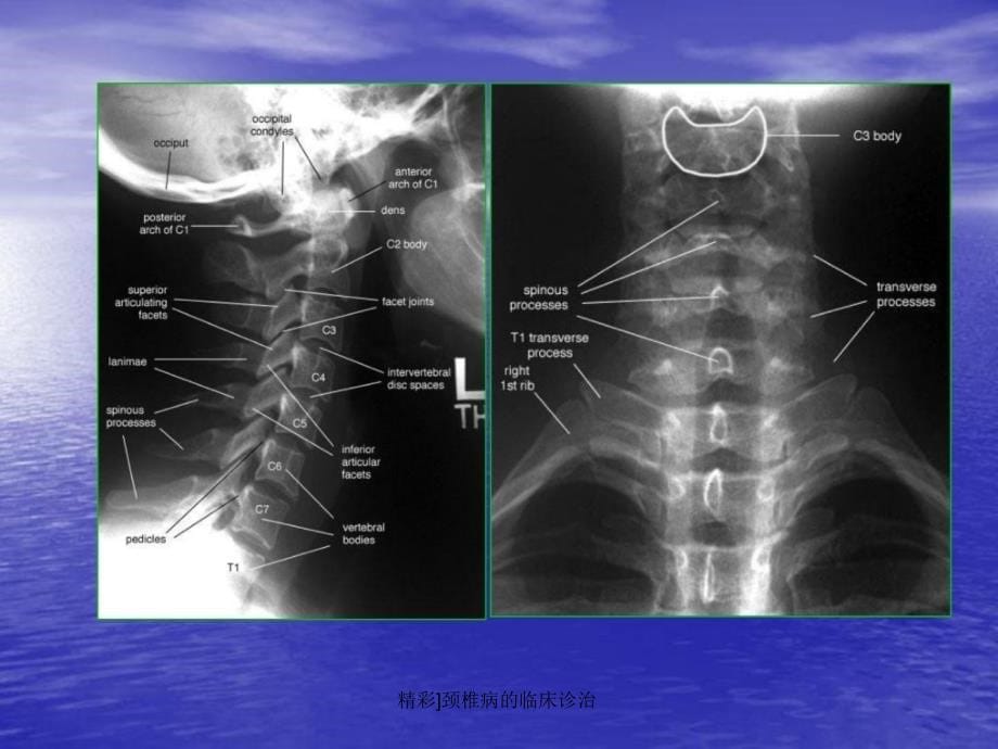精彩颈椎病的临床诊治课件_第5页