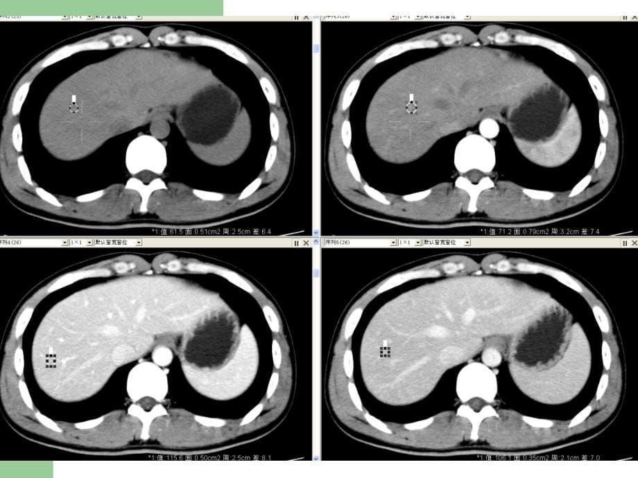 肝细胞癌hcc的影像诊断ppt课件_第5页