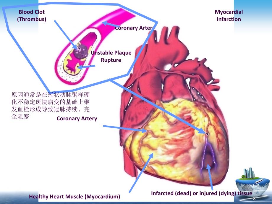 心肌梗死病理病理生理和临床表现ppt课件_第3页