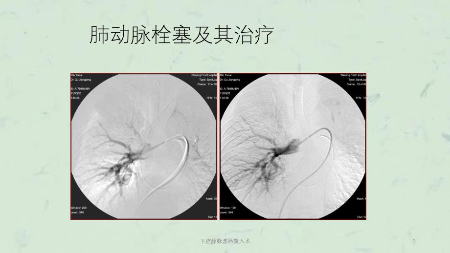 下腔静脉滤器置入术课件_第3页