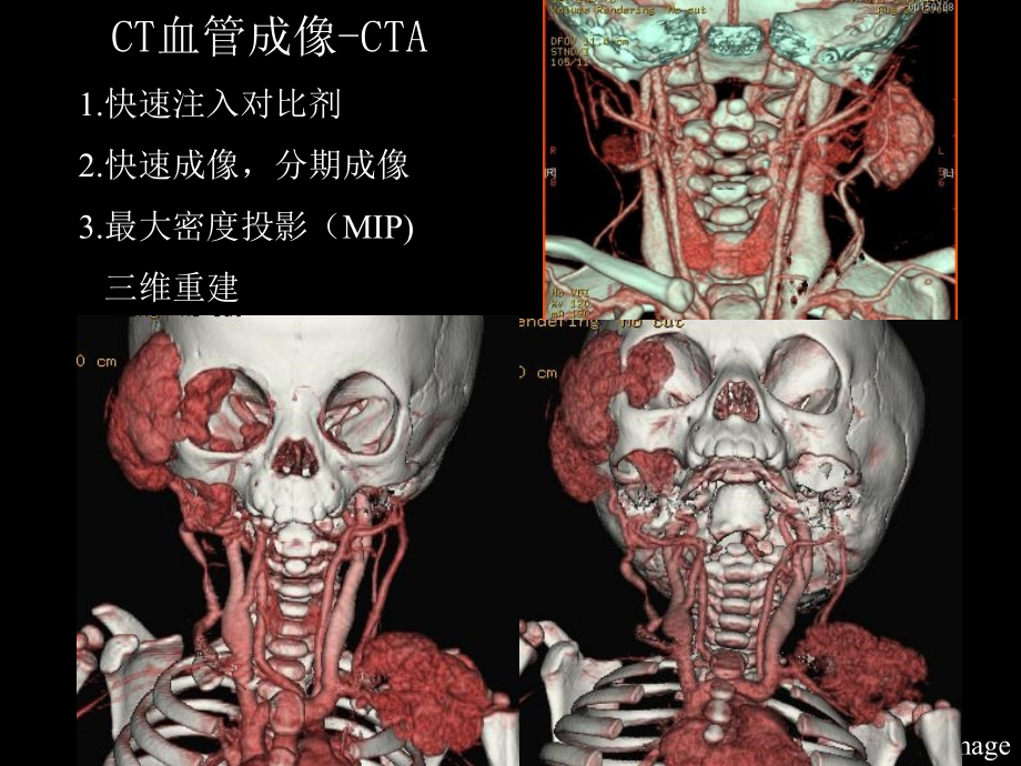 CTMR在儿科的应用课件_第3页