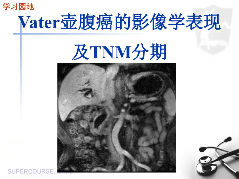 Vater壶腹癌的影像学表现及TNM分期_第1页