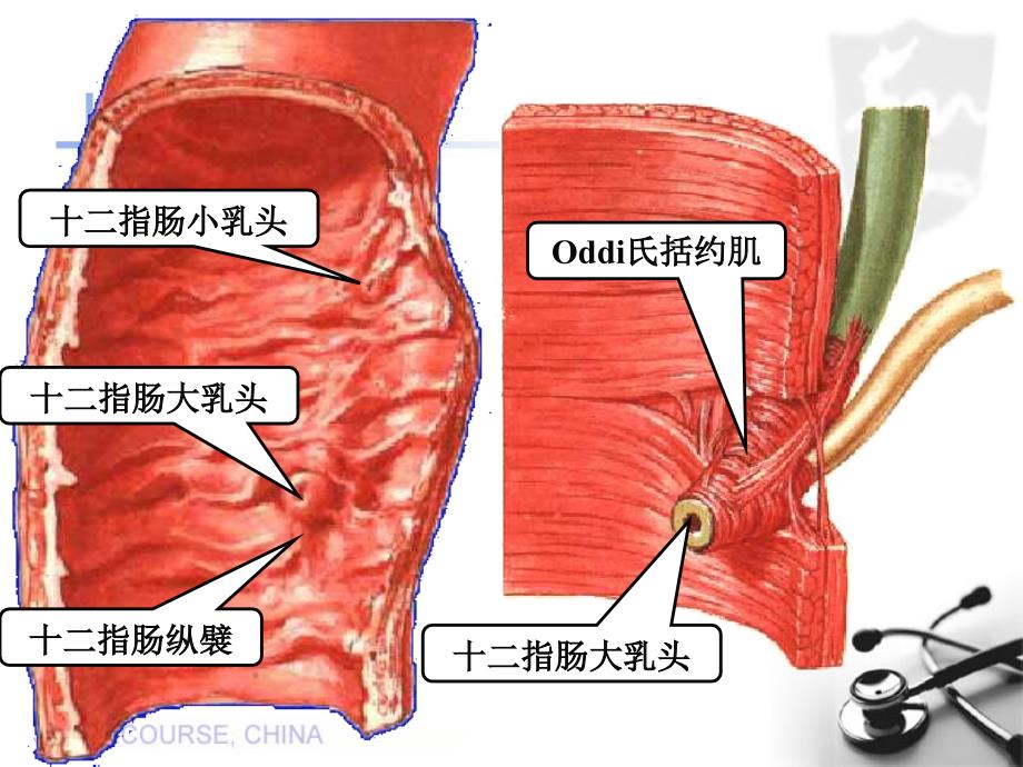 Vater壶腹癌的影像学表现及TNM分期_第3页