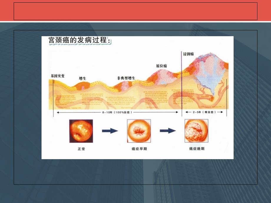 低度CIN病变PPT课件_第3页