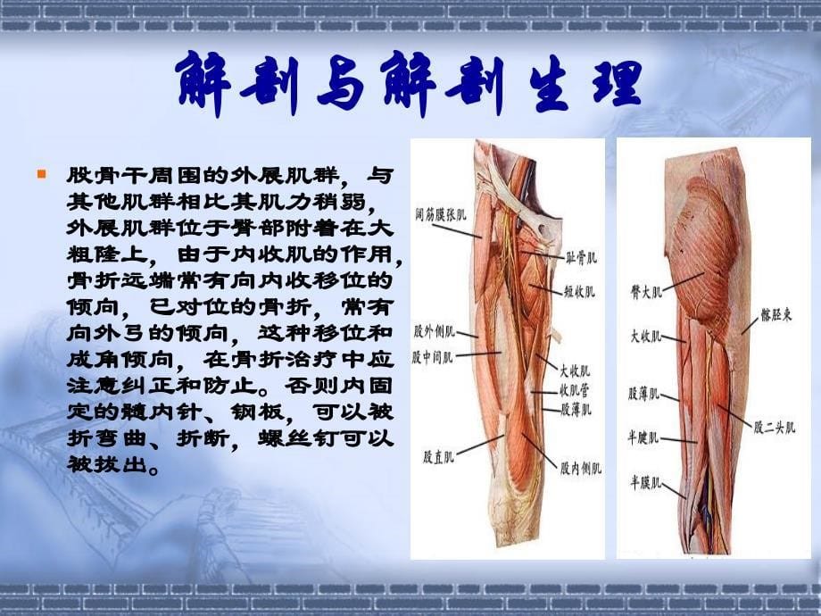 股骨干骨折课件_第5页