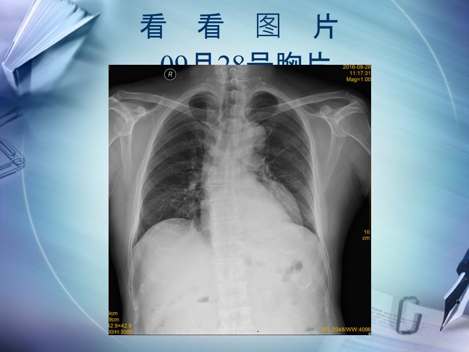 肺脓肿病例讨论(模板)_第3页