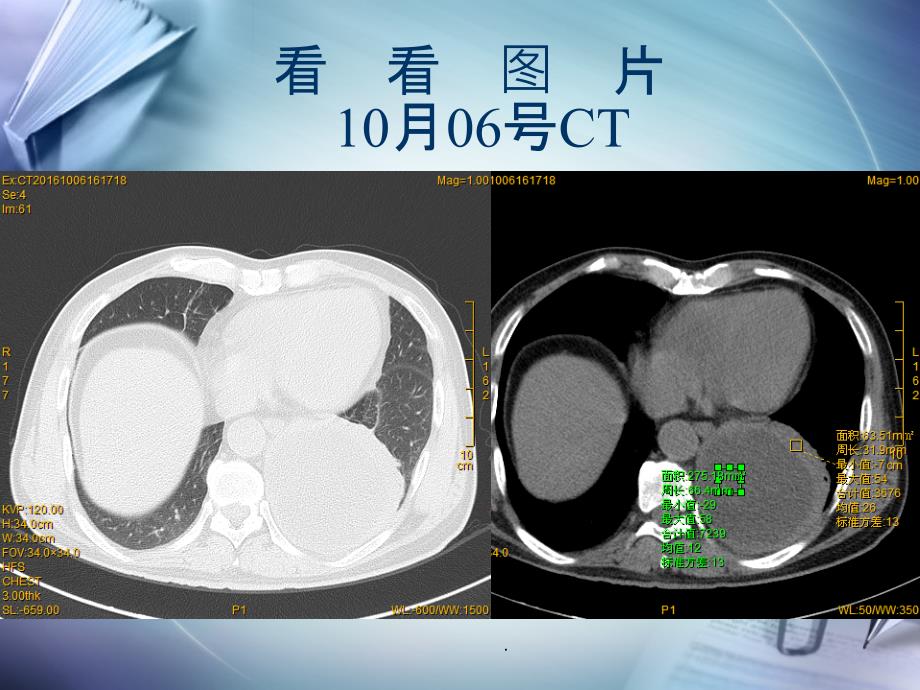 肺脓肿病例讨论(模板)_第4页