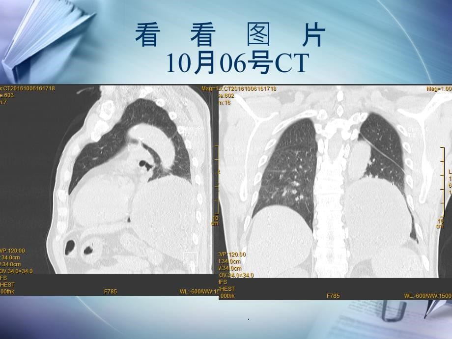 肺脓肿病例讨论(模板)_第5页