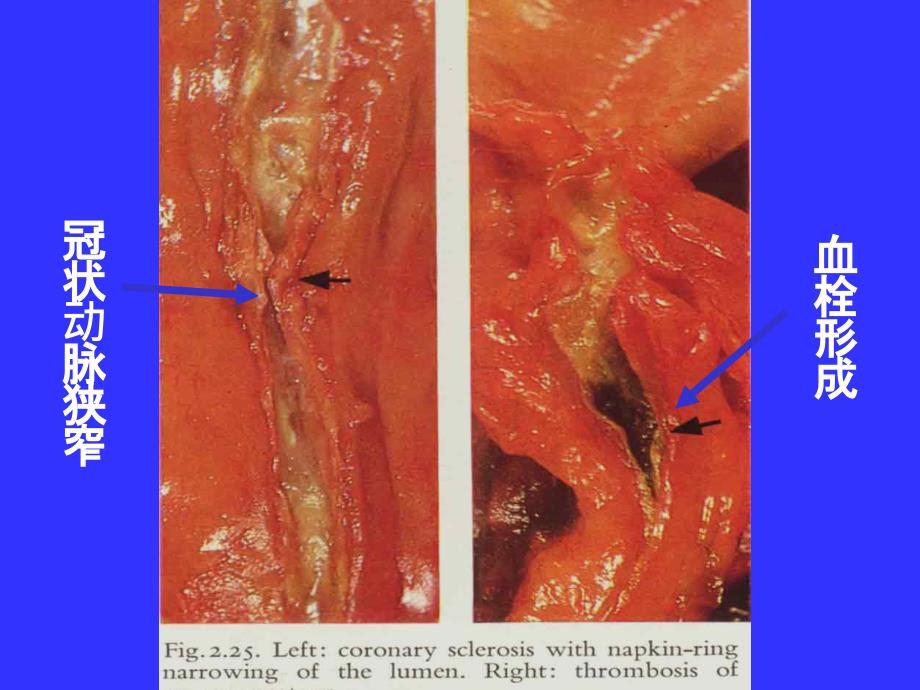 病理学课件：冠心病_第4页