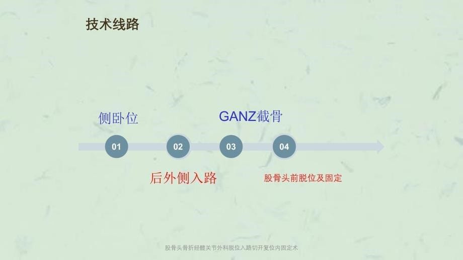 股骨头骨折经髋关节外科脱位入路切开复位内固定术课件_第5页