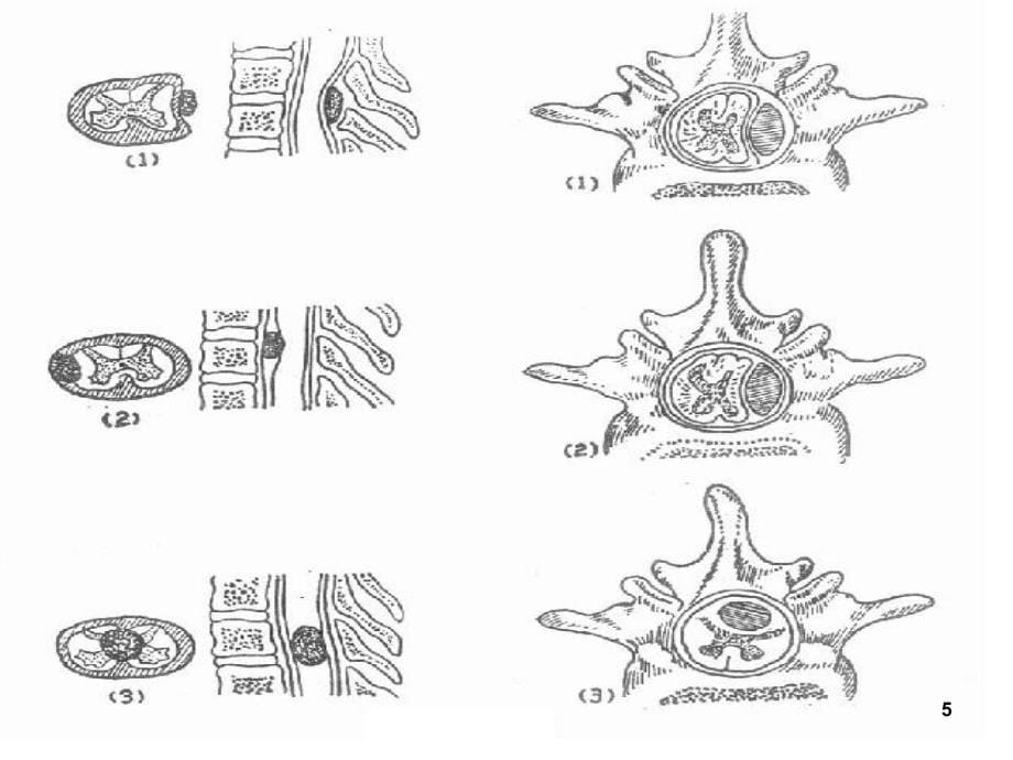 椎管内脊膜瘤的围手术期护理课堂PPT_第5页