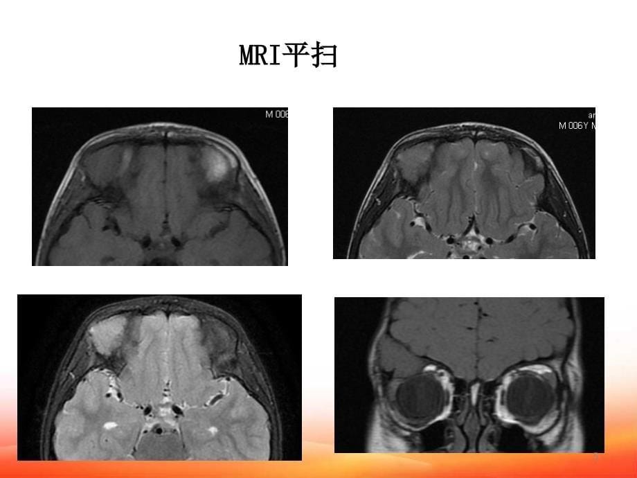 骨化性纤维瘤PPT参考幻灯片_第5页