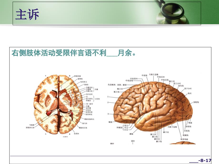 脑卒中康复病例汇报精选版_第3页