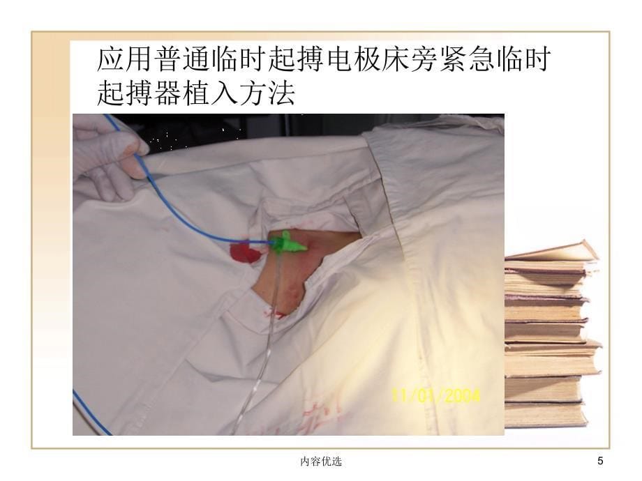 床旁紧急临时起搏器植入术严选内容_第5页