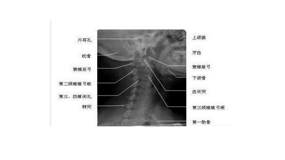 颈椎斜位摄影_第5页