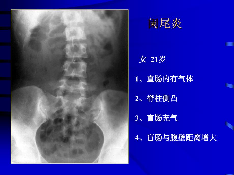 医学影像诊断课件图文详解完整版急腹症影像诊断学_第3页