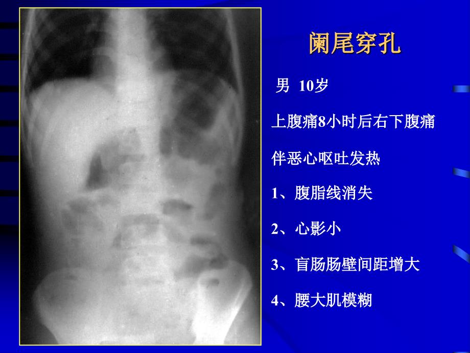 医学影像诊断课件图文详解完整版急腹症影像诊断学_第4页