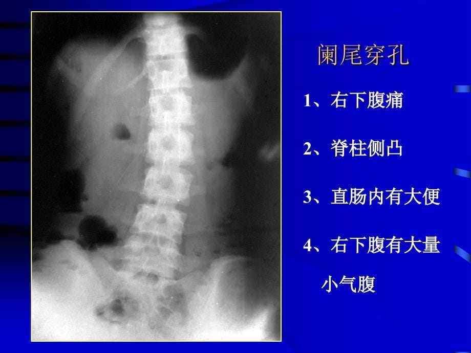 医学影像诊断课件图文详解完整版急腹症影像诊断学_第5页